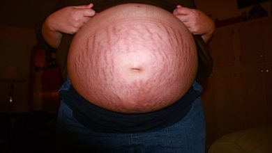 Photo of Stretch Mark : Common Causes and Natural Remedies